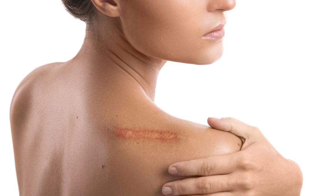 Treatment of Scars